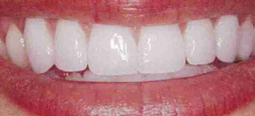 A closeup of teeth after porcelain veneers are fitted