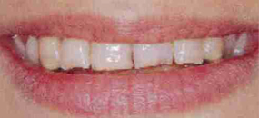 A closeup of teeth before porcelain veneers are fitted